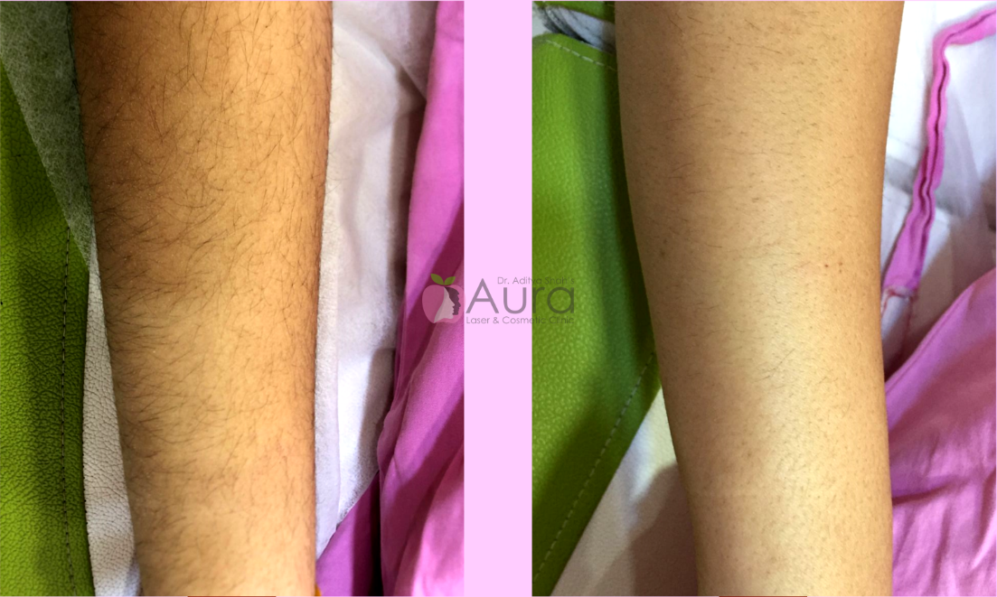 Full Arms Laser Hair Reduction