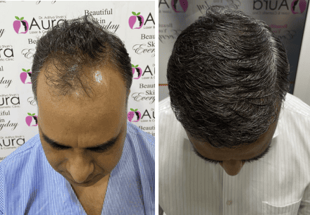Male Pattern Hair Thinning