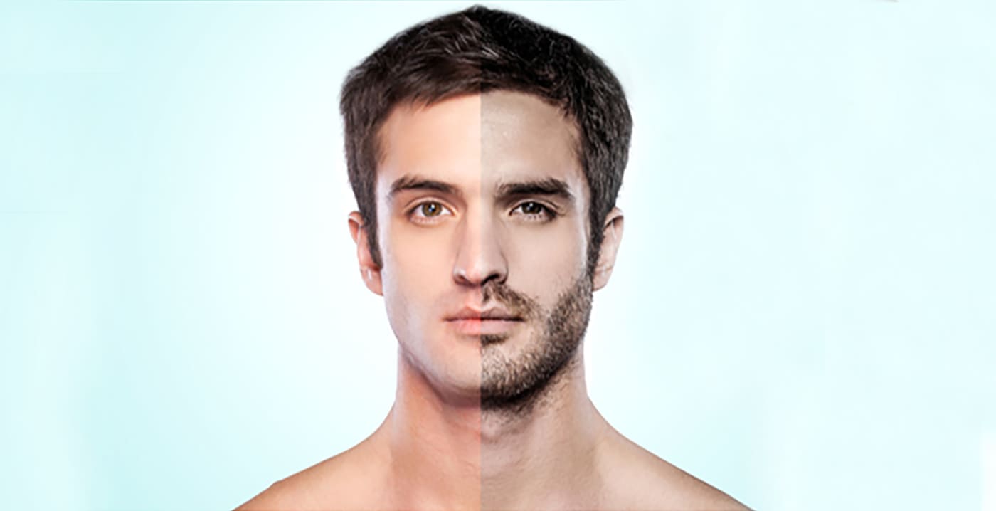 Beard Transplant