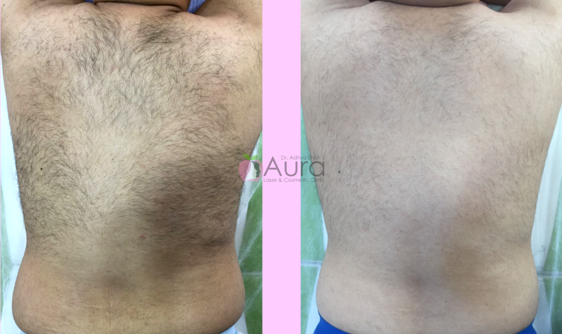 Back Laser Hair Reduction