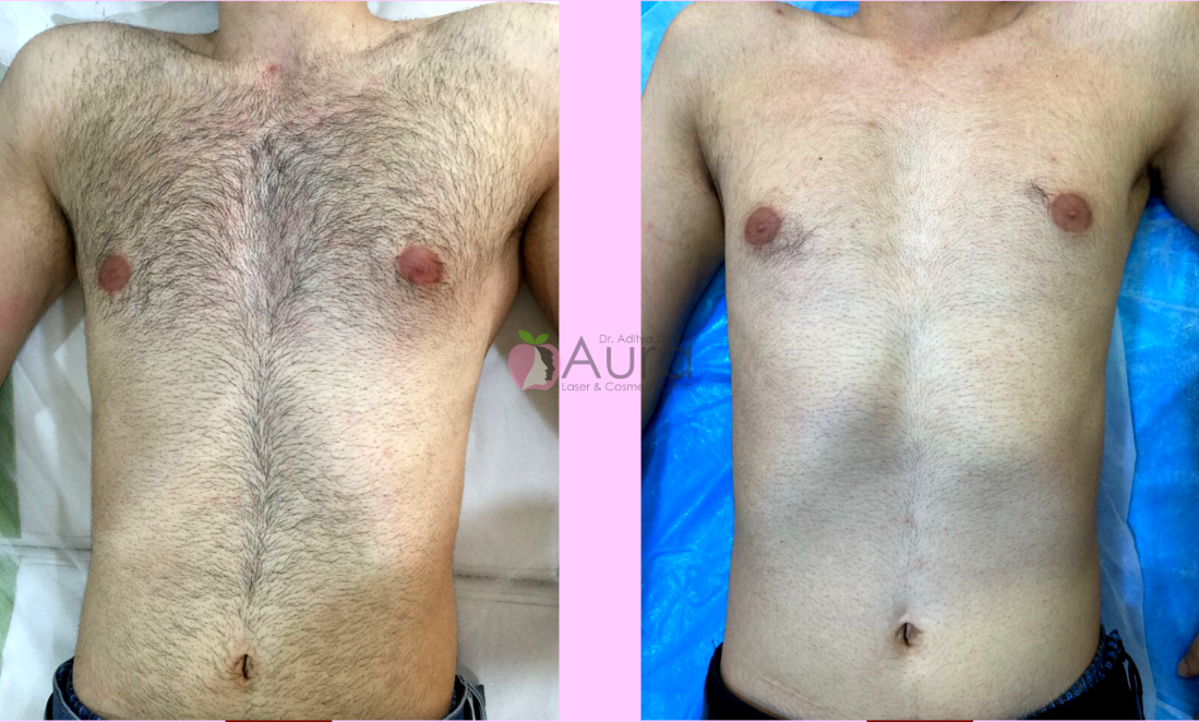 Chest & Abdomen Laser Hair Reduction
