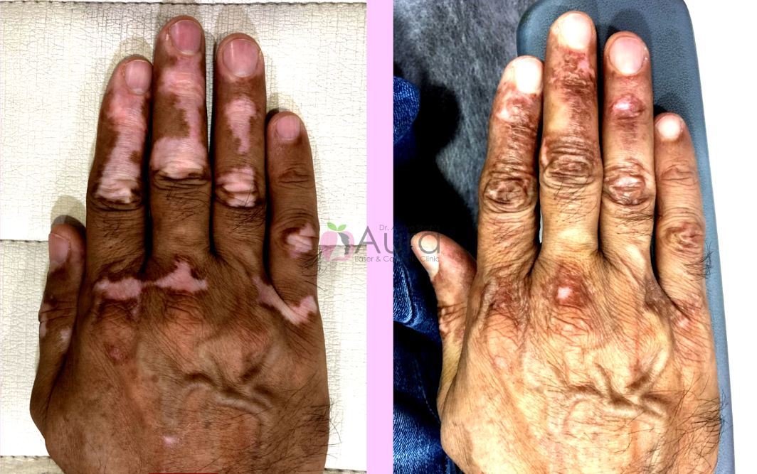 Vitiligo Treatment