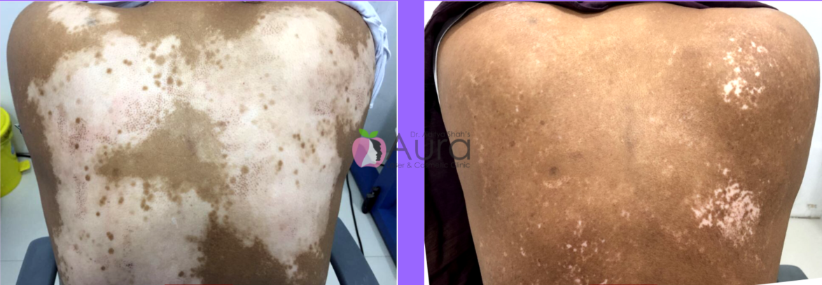 Vitiligo Treatment – Back