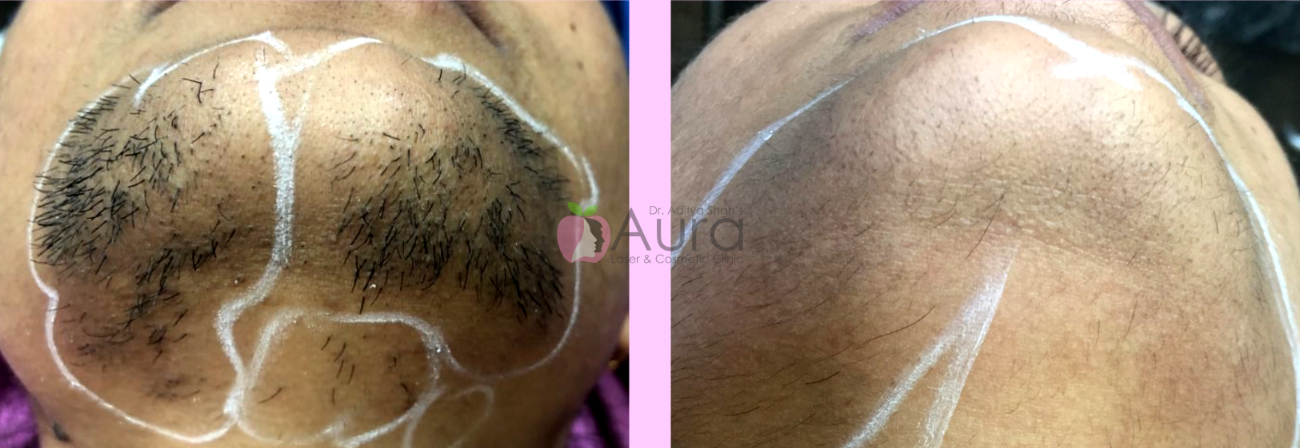 Chin Laser Hair Reduction