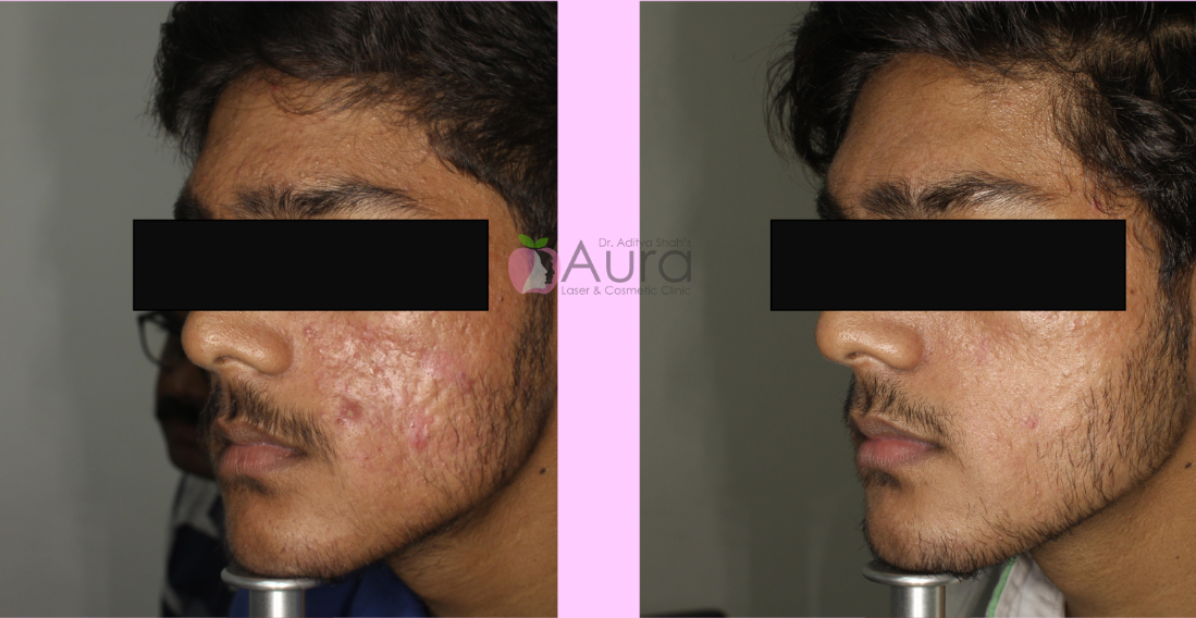 CO2 Fractional Laser for Acne Scars