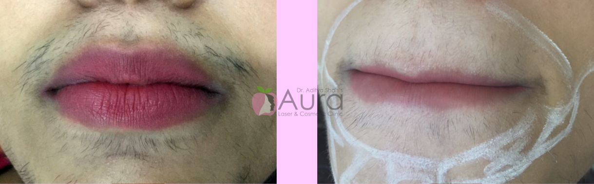 LHR Upper & Lower Lips