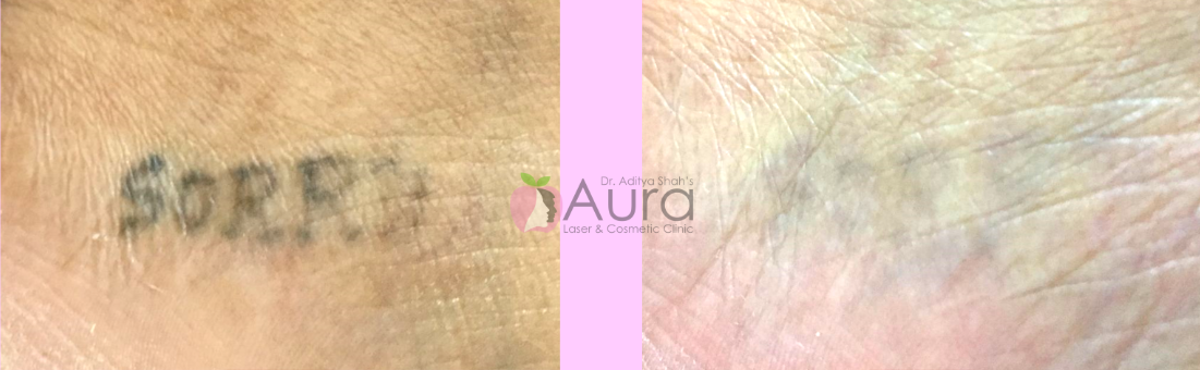Laser Tattoo Removal