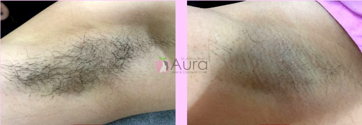 LHR Underarms